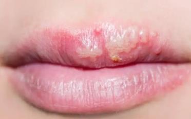 为什么每年嘴唇都长一次疱疹(每年嘴唇都要长疱疹怎么避免)